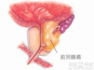 快查前列腺癌的3种症状。